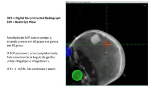 DRR = Digital Reconstructed Radiograph
BEV = Beam Eye View
Resultado do BEV para o campo 1,
estando a mesa em 60 graus e o gantry
em 30 graus.
O BEV percorre o arco completamente.
Para movimentar o ângulo de gantry
utilize <PageUp> e <PageDown>.
<F4> e <CTRL-F4> controlan o zoom.
 