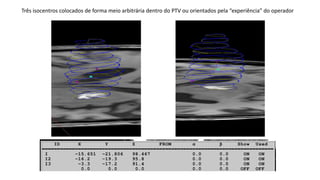 Três isocentros colocados de forma meio arbitrária dentro do PTV ou orientados pela “experiência” do operador
 
