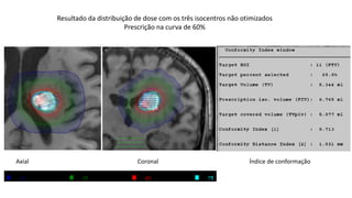 Resultado da distribuição de dose com os três isocentros não otimizados
Prescrição na curva de 60%
Axial Coronal Índice de conformação
 