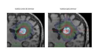 Isodose antes de otimizar Isodose após otimizar
 