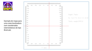 Exemplo de mapa para
uma caixa localizadora
com coordenadas
estereotáxicas do tipo
BrainLab.
 