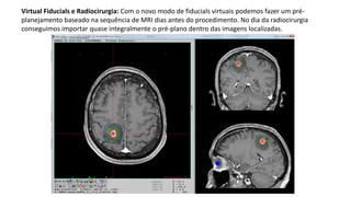 Virtual Fiducials e Radiocirurgia: Com o novo modo de fiducials virtuais podemos fazer um pré-
planejamento baseado na sequência de MRI dias antes do procedimento. No dia da radiocirurgia
conseguimos importar quase integralmente o pré-plano dentro das imagens localizadas.
 