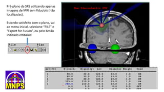Pré-plano da SRS utilizando apenas
imagens de MRI sem fiducials (não
localizadas).
Estando satisfeito com o plano, vai
ao menu inicial, selecione “FILE” e
“Export for Fusion”, ou pelo botão
indicado embaixo:
 