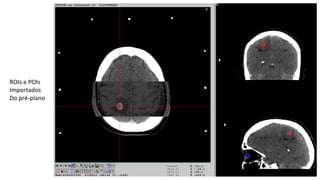 ROIs e POIs
Importados
Do pré-plano
 
