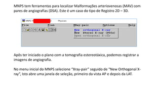 MNPS tem ferramentas para localizar Malformações arteriovenosas (MAV) com
pares de angiografias (DSA). Este é um caso do tipo de Registro 2D – 3D.
Apôs ter iniciado o plano com a tomografia estereotáxica, podemos registrar a
imagens de angiografia.
No menu inicial do MNPS selecione “Xray-pair” seguido de “New Orthogonal X-
ray”, Isto abre uma janela de seleção, primeiro da vista AP e depois da LAT.
 