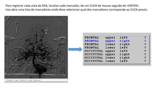 Para registrar cada vista de DSA, localize cada marcador, de um CLICK de mouse seguido de <ENTER>.
Isso abre uma lista de marcadores onde deve selecionar qual dos marcadores corresponde ao CLICK previo.
 