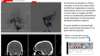Ao terminar de identificar o último
marcados na vista LAT, ambas vistas
de DSA ficam registradas no volume
estereotáxico da CT e ao movimentar
o cursor sobre as imagens de DSA
vemos as coordenadas estereotáxicas
sendo reportadas no título da janela
Windows (window’s caption).
O cursor também é acompanhado
pelas reconstruções de stereo-CT na
parte inferior da janela.
Botões e coordenadas na parte
inferior esquerda da janela
 