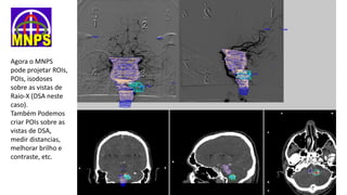 Agora o MNPS
pode projetar ROIs,
POIs, isodoses
sobre as vistas de
Raio-X (DSA neste
caso).
Também Podemos
criar POIs sobre as
vistas de DSA,
medir distancias,
melhorar brilho e
contraste, etc.
 