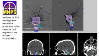 Isodoses de 50%
(verde) e 80%
(vermelha)
projetadas sobre
vistas de DAS
registradas no
espaço
estereotáxico.
 