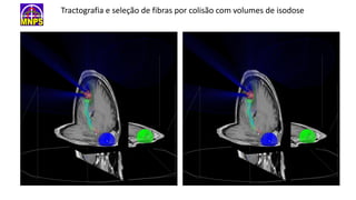 Tractografia e seleção de fibras por colisão com volumes de isodose
 