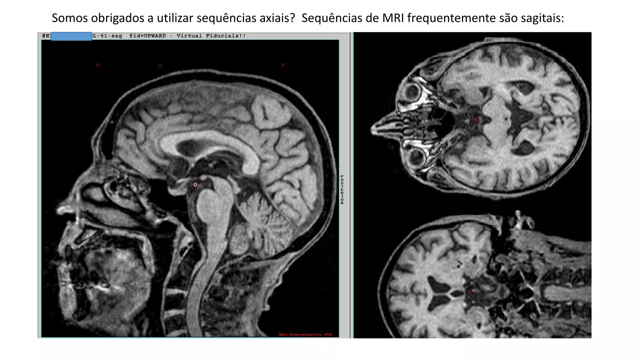 Somos obrigados a utilizar sequências axiais? Sequências de MRI frequentemente são sagitais:
 
