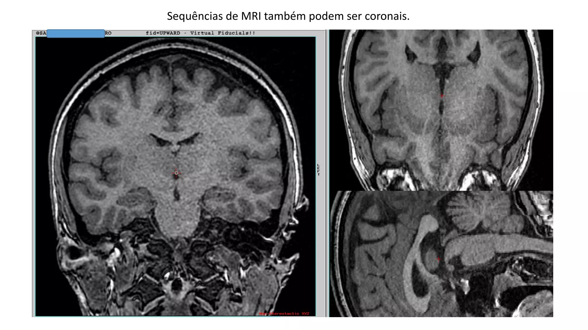 Sequências de MRI também podem ser coronais.
 
