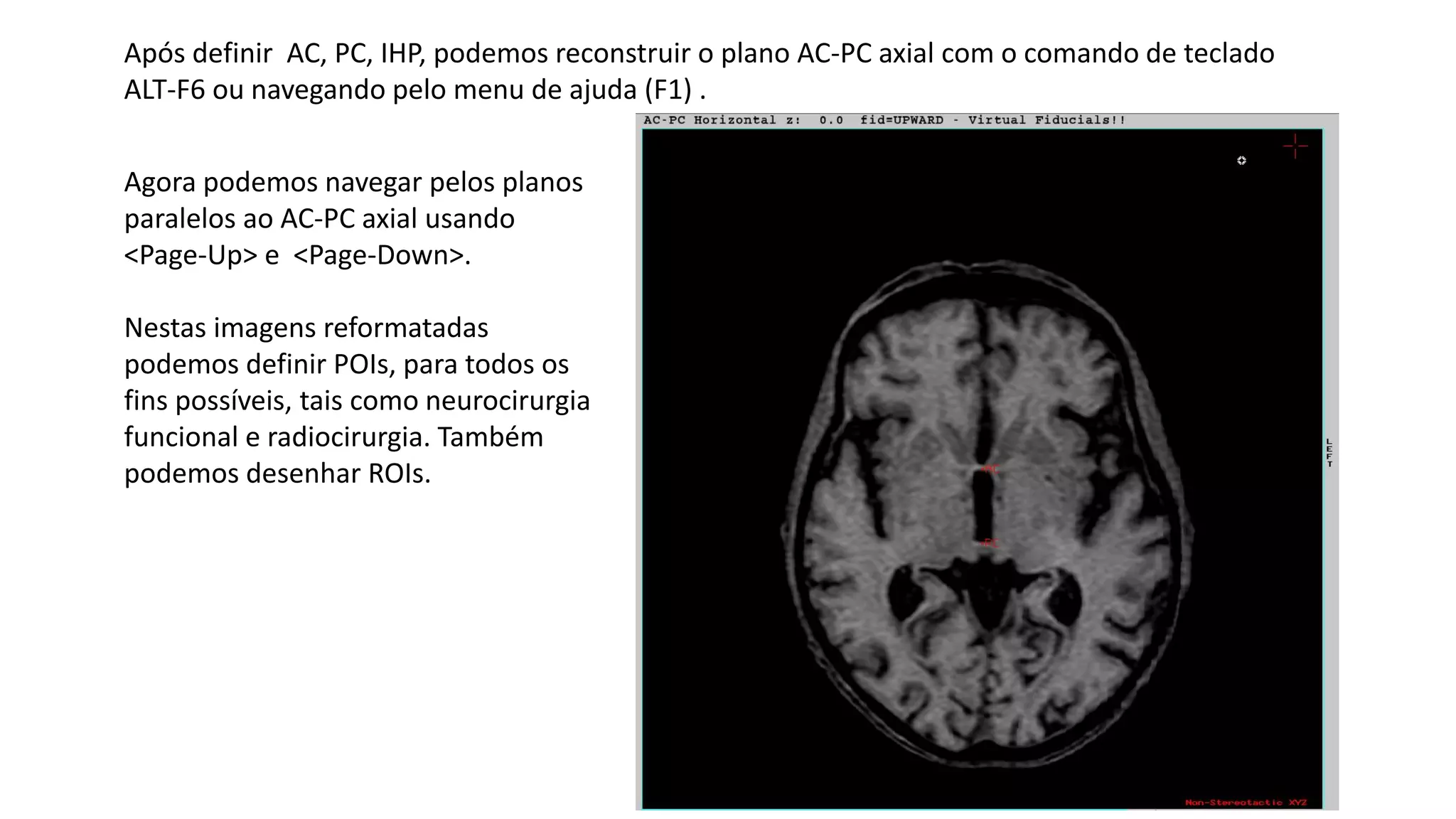 Após definir AC, PC, IHP, podemos reconstruir o plano AC-PC axial com o comando de teclado
ALT-F6 ou navegando pelo menu de ajuda (F1) .
Agora podemos navegar pelos planos
paralelos ao AC-PC axial usando
<Page-Up> e <Page-Down>.
Nestas imagens reformatadas
podemos definir POIs, para todos os
fins possíveis, tais como neurocirurgia
funcional e radiocirurgia. Também
podemos desenhar ROIs.
 