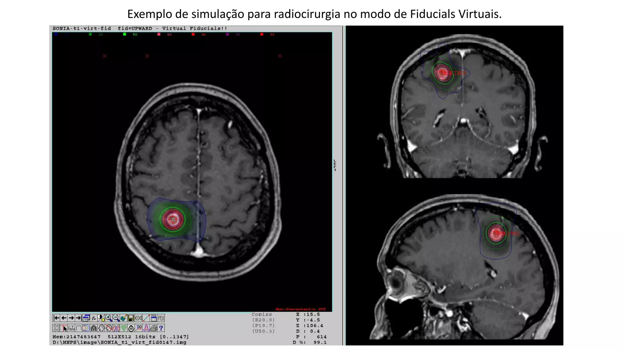 Exemplo de simulação para radiocirurgia no modo de Fiducials Virtuais.
 