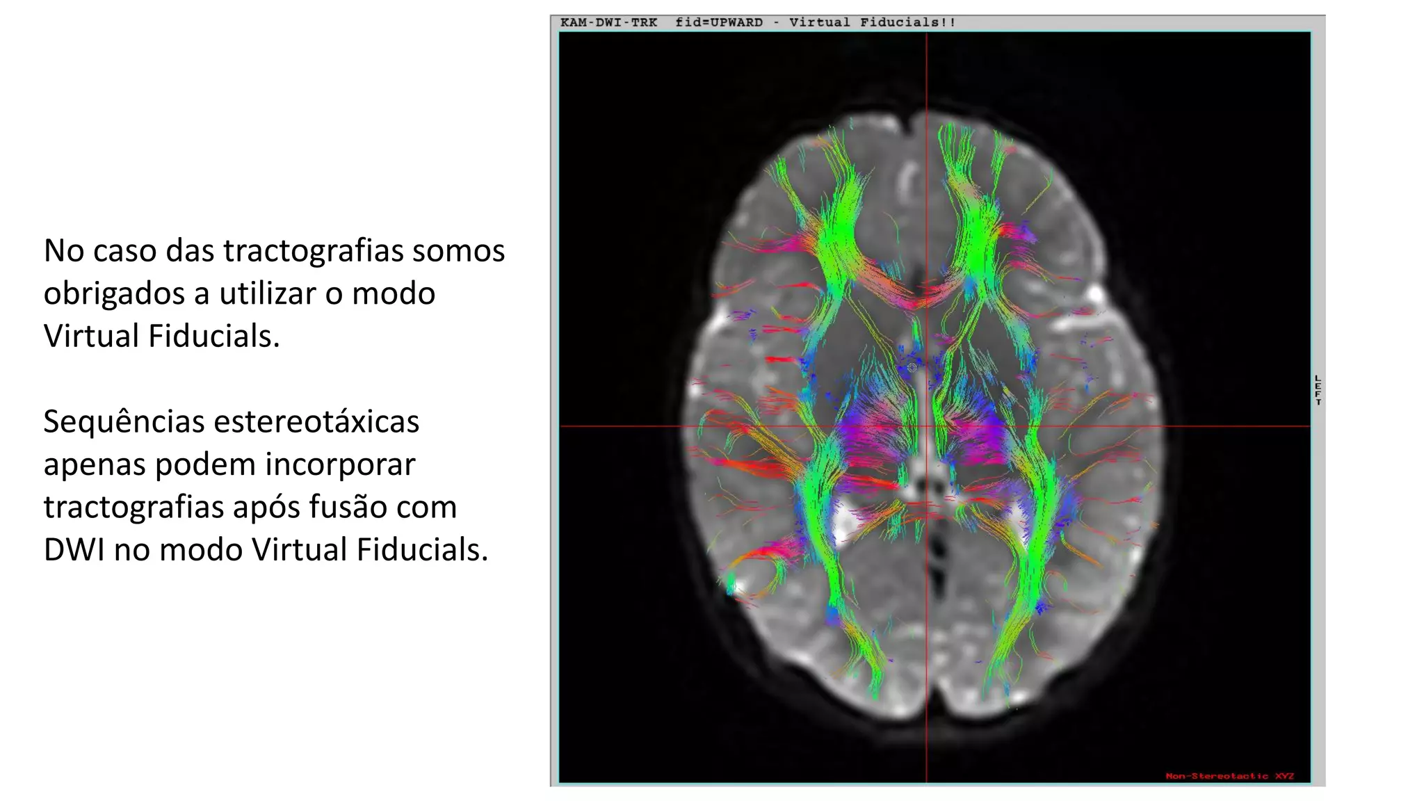 No caso das tractografias somos
obrigados a utilizar o modo
Virtual Fiducials.
Sequências estereotáxicas
apenas podem incorporar
tractografias após fusão com
DWI no modo Virtual Fiducials.
 