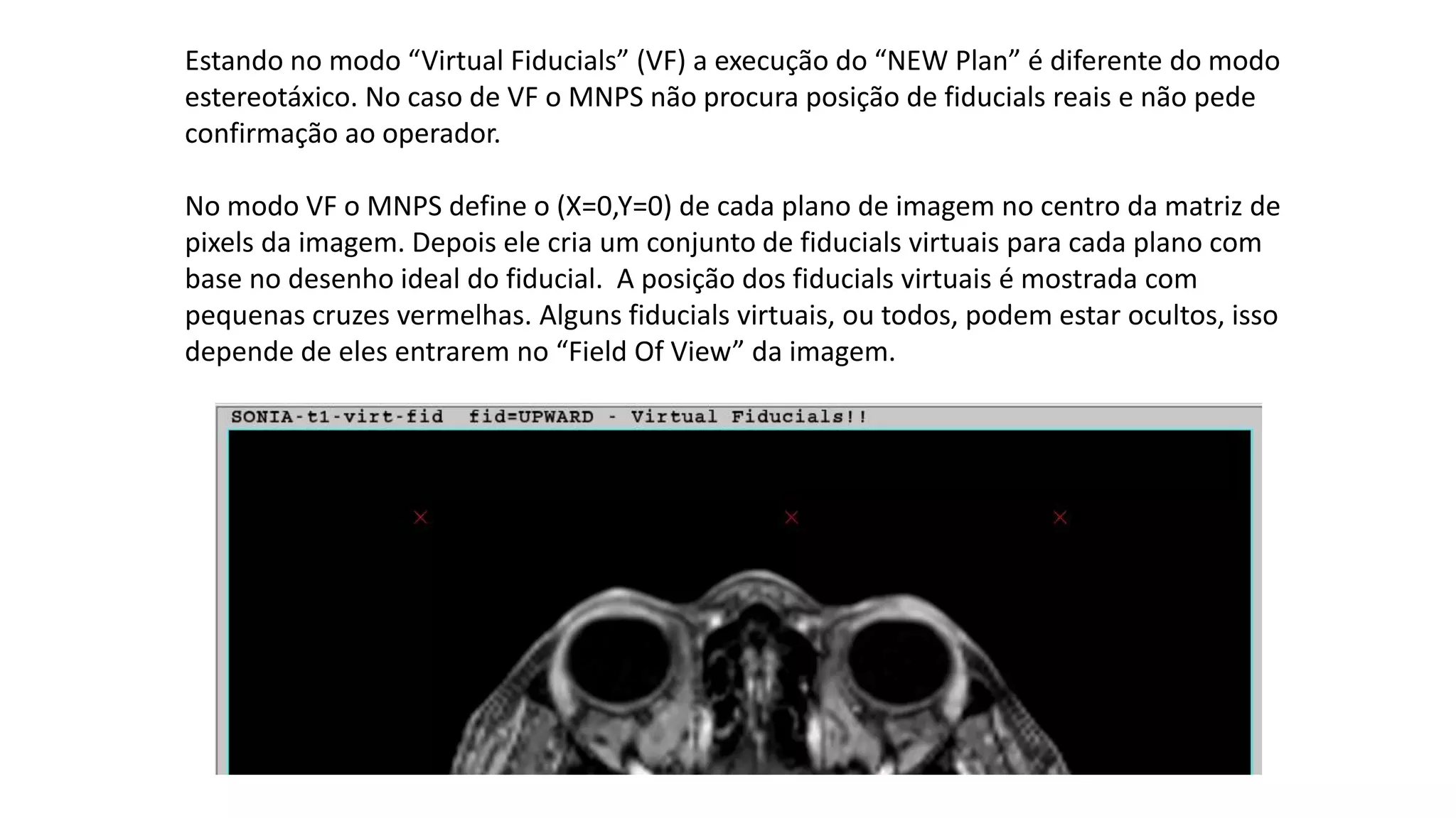 Estando no modo “Virtual Fiducials” (VF) a execução do “NEW Plan” é diferente do modo
estereotáxico. No caso de VF o MNPS não procura posição de fiducials reais e não pede
confirmação ao operador.
No modo VF o MNPS define o (X=0,Y=0) de cada plano de imagem no centro da matriz de
pixels da imagem. Depois ele cria um conjunto de fiducials virtuais para cada plano com
base no desenho ideal do fiducial. A posição dos fiducials virtuais é mostrada com
pequenas cruzes vermelhas. Alguns fiducials virtuais, ou todos, podem estar ocultos, isso
depende de eles entrarem no “Field Of View” da imagem.
 