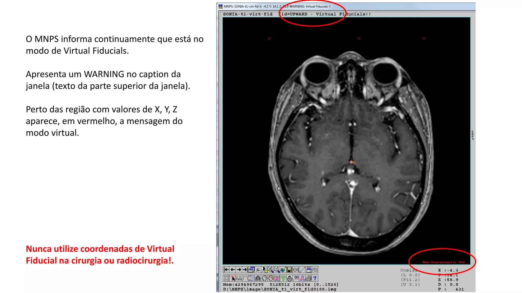 O MNPS informa continuamente que está no
modo de Virtual Fiducials.
Apresenta um WARNING no caption da
janela (texto da parte superior da janela).
Perto das região com valores de X, Y, Z
aparece, em vermelho, a mensagem do
modo virtual.
Nunca utilize coordenadas de Virtual
Fiducial na cirurgia ou radiocirurgia!.
 