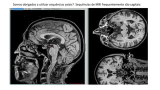 Somos obrigados a utilizar sequências axiais? Sequências de MRI frequentemente são sagitais:
 