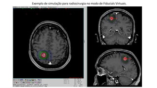 Exemplo de simulação para radiocirurgia no modo de Fiducials Virtuais.
 