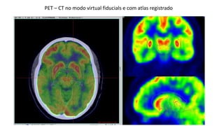 PET – CT no modo virtual fiducials e com atlas registrado
 