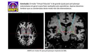Conclusão: O modo “Virtual Fiducials” é de grande ajuda para pré-planejar
estereotaxia em geral e para fazer avaliações pós-operatórias. Apenas devemos
lembrar que as coordenadas deste modo não são estereotáxicas.
MNPS em modo VF para pré-planejar implante de DBS.
 