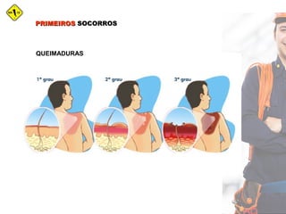 PRIMEIROSPRIMEIROS SOCORROSSOCORROS
QUEIMADURAS
 