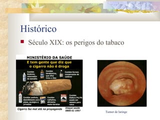 Histórico 
 Século XIX: os perigos do tabaco 
Tumor de laringe 
 