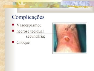 Complicações 
 Vasoespasmo; 
 necrose tecidual 
secundária; 
 Choque 
 