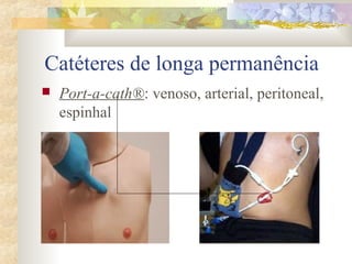 Catéteres de longa permanência 
 Port-a-cath®: venoso, arterial, peritoneal, 
espinhal 
 