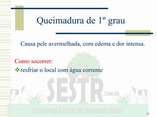 77
Queimadura de 1º grau
Causa pele avermelhada, com edema e dor intensa.
Como socorrer:
resfriar o local com água corrente
 