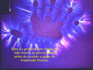 Esta é a primeira foto tirada da
mão inteira do garoto Felipe
antes de receber o passe de
transfusão fluídica.
 