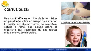 SEGURIDAD - SALUD - MEDIO AMBIENTE BRIGADAS DE EMERGENCIA
CONTUSIONES:
Una contusión es un tipo de lesión física
no penetrante sobre un cuerpo causada por
la acción de objetos duros, de superficie
obtusa o roma, que actúan sobre el
organismo por intermedio de una fuerza
más o menos considerable.
184
HEMATOMA (chichón)
EQUIMOSIS DE LA ZONA (Moretón)
 