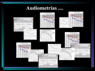 94
Audiometrias ....
 