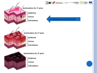 Os diferentes graus de Queimaduras
 