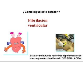 ¿Como sigue este corazón?
Esta arritmia puede revertirse rápidamente con
un choque eléctrico llamado DESFIBRILACION
Fibrilación
ventricular
 
