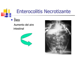 .Enterocolitis Necrotizante- neonatología | PPT