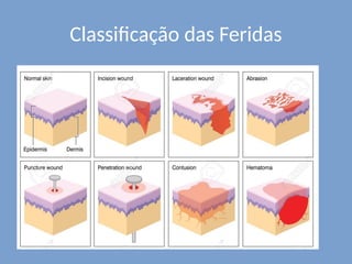 Classificação das Feridas
 