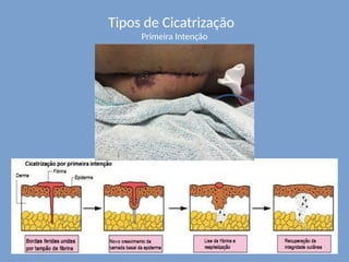 Tipos de Cicatrização
Primeira Intenção
 