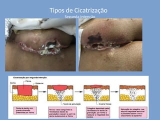 Tipos de Cicatrização
Segunda Intenção
 