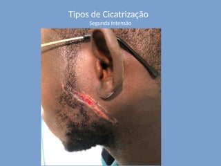 Tipos de Cicatrização
Segunda Intensão
 