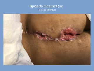 Tipos de Cicatrização
Terceira Intenção
 