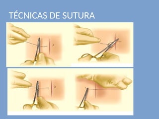 TÉCNICAS DE SUTURA
 