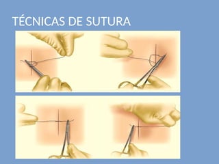 TÉCNICAS DE SUTURA
 