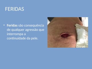 FERIDAS
• Feridas são consequência
de qualquer agressão que
interrompa a
continuidade da pele.
 