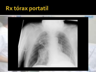 No sustituye a la IOT, sino que la precede, intentando evitarla.