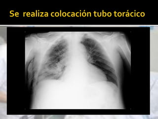 Incluso teóricamente “contraindicada” en muchos de los pacientes que la empleamos (con éxito)Criterios de ExclusiónParada respiratoria (o inminente)