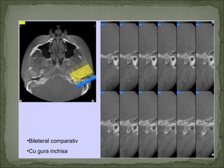 •Bileteral comparativ
•Cu gura inchisa
 