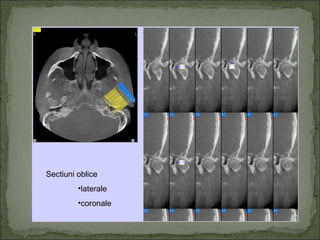 Sectiuni oblice
         •laterale
         •coronale
 