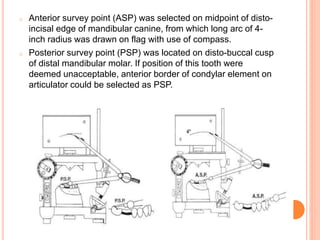 o Anterior survey point (ASP) was selected on midpoint of disto-
incisal edge of mandibular canine, from which long arc of 4-
inch radius was drawn on flag with use of compass.
o Posterior survey point (PSP) was located on disto-buccal cusp
of distal mandibular molar. If position of this tooth were
deemed unacceptable, anterior border of condylar element on
articulator could be selected as PSP.
 