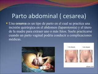 Parto abdominal ( cesarea) Una  cesarea  es un tipo de parto en el cual se practica una incisión quirúrgica en el abdomen (laparotomía) y el útero de la madre para extraer uno o más fetos. Suele practicarse cuando un parto vaginal podría conducir a complicaciones médicas. 